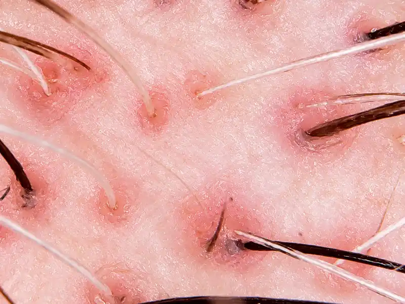 Inflamação perifolicular identificados pelo exame capilar